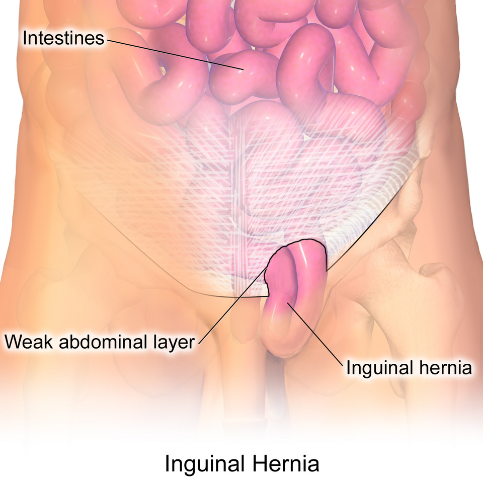 Advanced Laparoscopic Hernia Repair