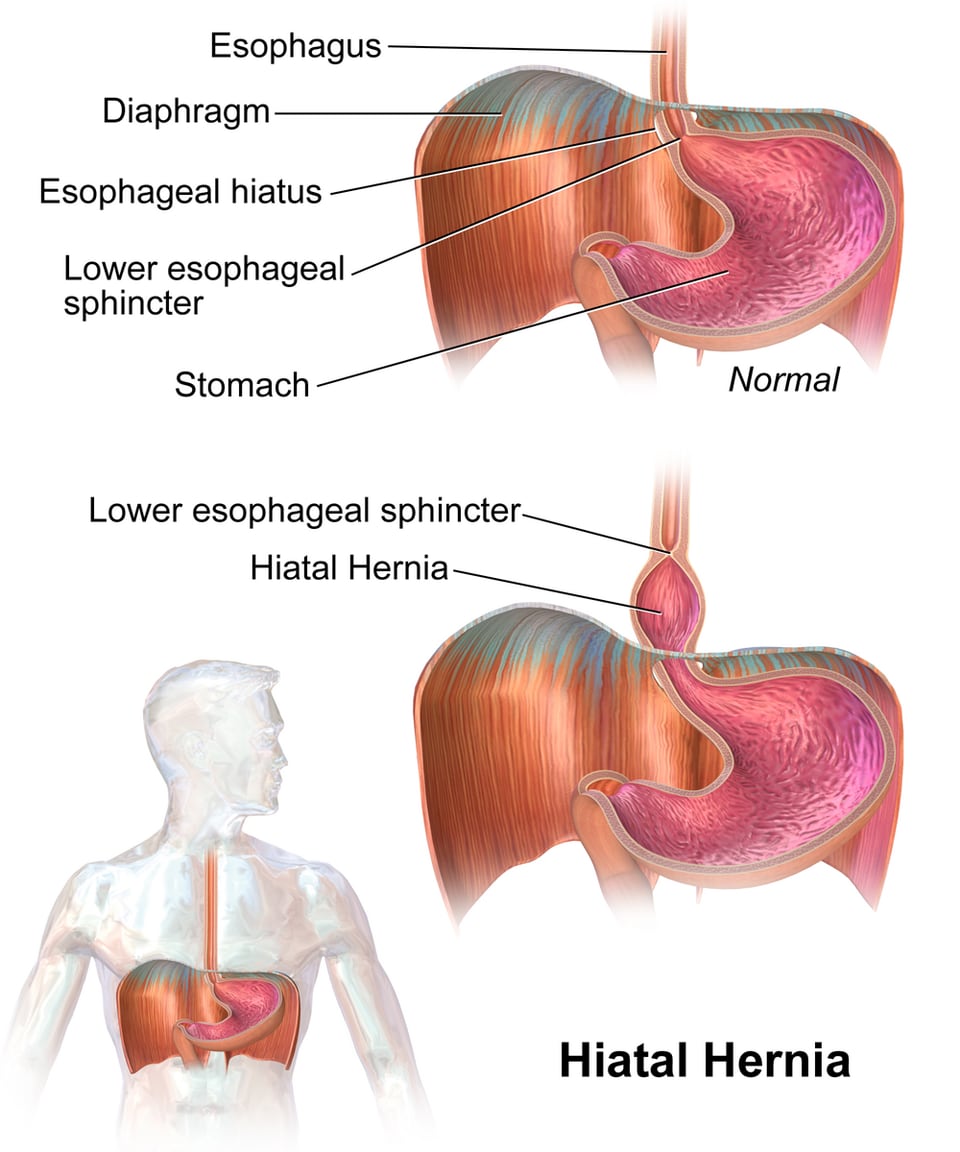 Laparoscopic Hiatal Hernia Surgery