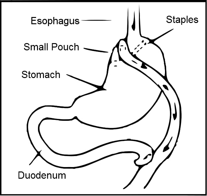 Obesity & Diabetes Surgery (Metabolic Surgery)