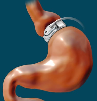 Revisional Bariatric Surgery