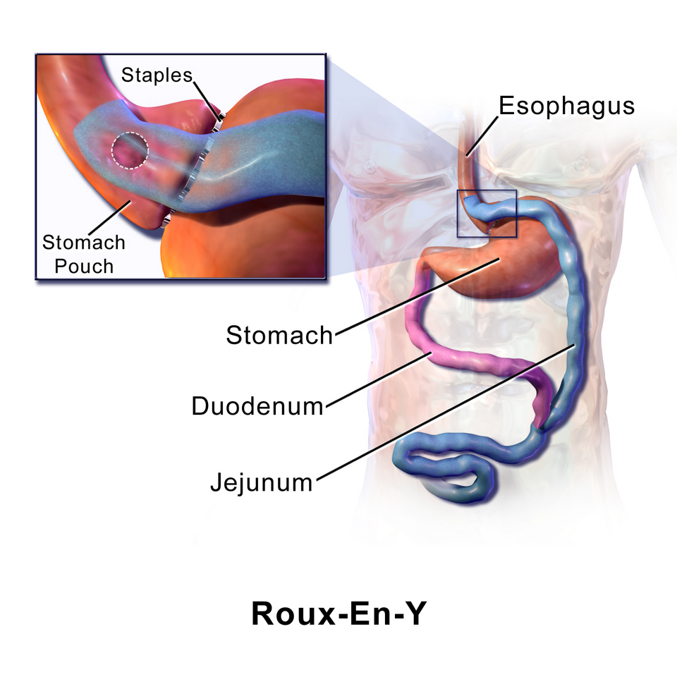 Roux-en-Y Gastric Bypass (RYGB)