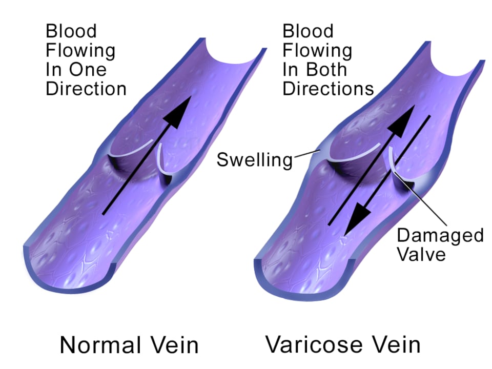 Varicose Vein Treatment